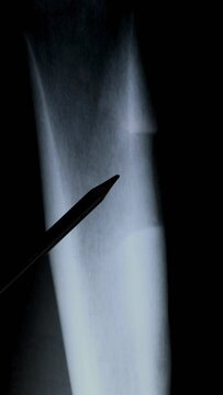 Doctor is analyzing x-ray scan about consequences of removing a tumor on the bone. Vertical footage.