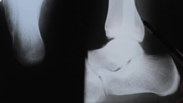 Calcaneus or heel bone destruction. Bone of the tarsus of the foot. Medical treatment concept. Diagnosis of the disease humans bones.