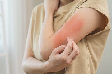 Dermatology asian young woman, girl allergy, allergic reaction from atopic, insect bites on her...