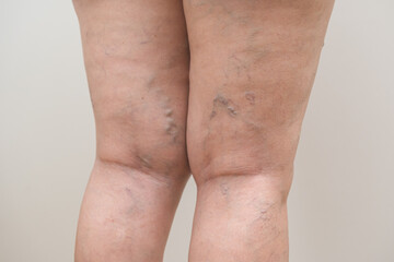 Health care beauty, varicose veins on skin of leg, woman showing vascular, thrombosis on legs isolated on background. Vascular disease, varicose vein problem. Treatment with medicine and cosmetology.