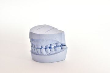 Dental impression of teeth
