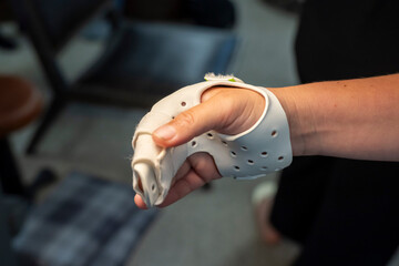 orthèse thermoformée pour consolidation de fracture