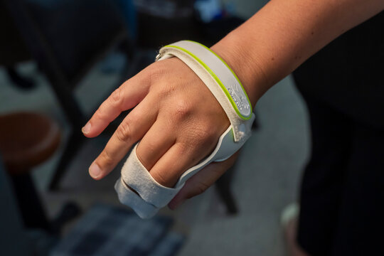 orth&egrave;se thermoform&eacute;e pour consolidation de fracture	