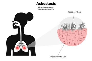 Asbestosis lungs diseases, lungs problem, lungs icon	
