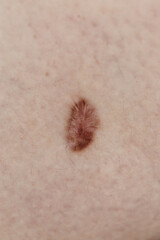 Small scar on the skin.