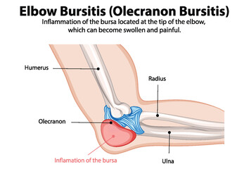 Diagram showing inflammation of elbow bursa