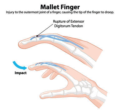 Diagram showing mallet finger injury details