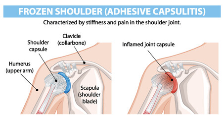 Diagram showing frozen shoulder condition and anatomy