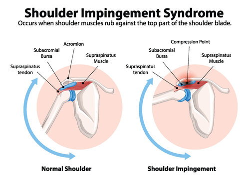 Comparison of normal shoulder and impingement
