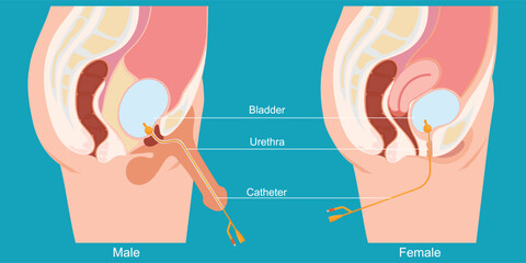 Urinary catheter in the male body and female body.