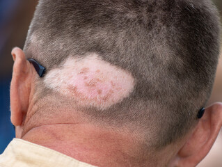 pigment spot on the head as a background.