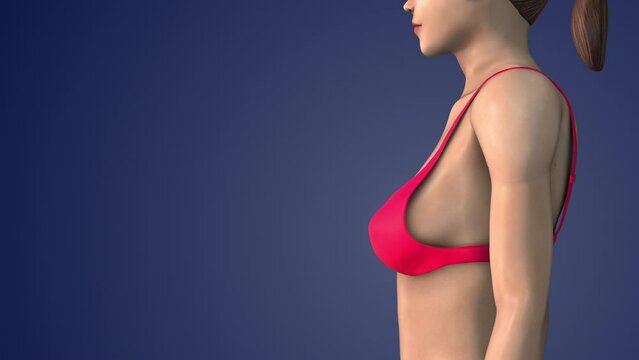 Mastopexy also known as a breast lift