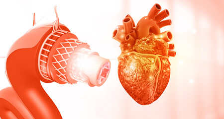 Human heart with cholesterol blocked artery. 3d illustration..