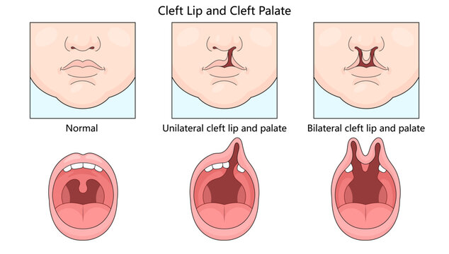 normal, unilateral cleft lip and palate, and bilateral cleft lip and palate conditions in infants diagram hand drawn schematic vector illustration. Medical science educational illustration