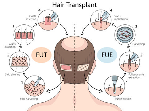 Follicular Unit Transplantation (FUT) and Follicular Unit Extraction (FUE) hair transplant techniques diagram hand drawn schematic vector illustration. Medical science educational illustration