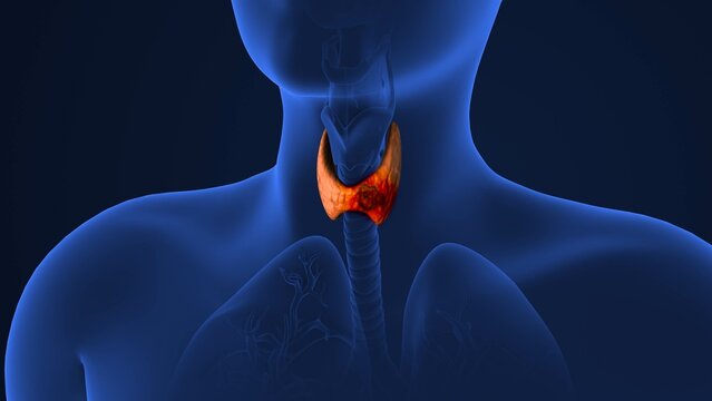 Tumor spread in the thyroid gland