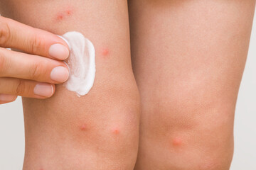 Young mother fingers applying white medical ointment on toddler leg on light gray background. Red...
