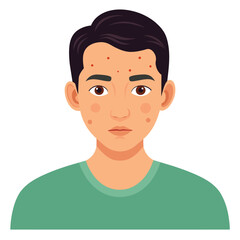 A cartoon depiction of a youthful male displaying acne on his facial skin