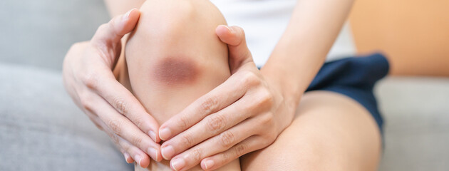 Close up of stain bruise wound on leg, contusion asian young woman, girl on joint knee from an...
