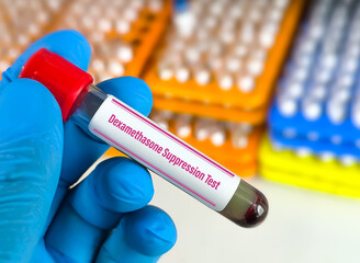 Fototapeta premium Dexamethasone Suppression Test measures the response of the adrenal glands to ACTH. Dexamethasone is given and levels of cortisol are measured