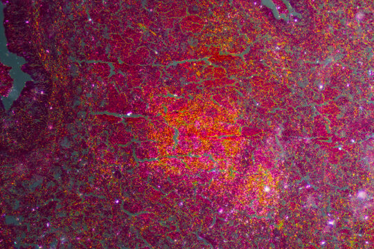 Micrograph of lobar pneumonia red hepatization stage