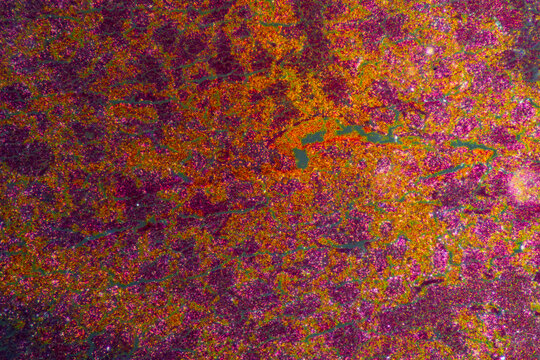 Micrograph of lobar pneumonia red hepatization stage