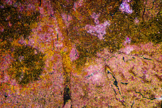 Micrograph of lobar pneumonia red hepatization stage