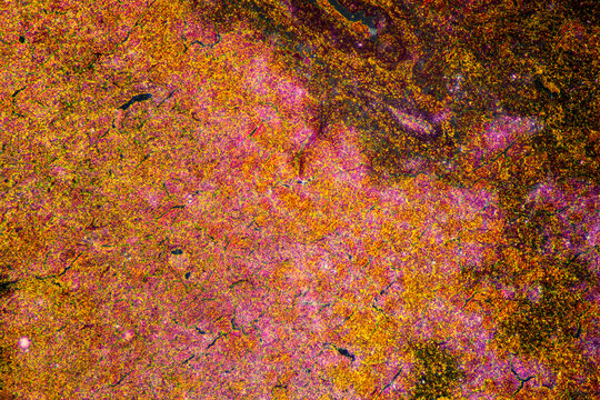 Micrograph of lobar pneumonia red hepatization stage