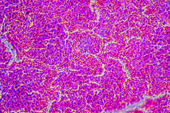 Micrograph of lobar pneumonia red hepatization stage