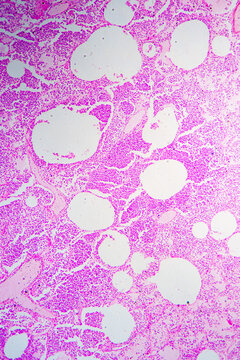 Micrograph of lobar pneumonia grey hepatization stage