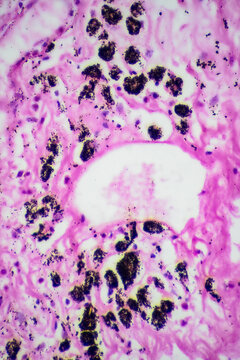 Micrograph of lobar pneumonia grey hepatization stage