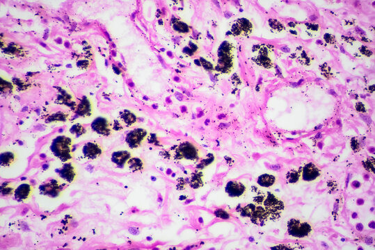 Micrograph of lobar pneumonia grey hepatization stage