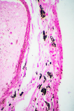 Micrograph of lobar pneumonia grey hepatization stage