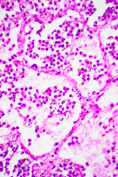 Micrograph of lobar pneumonia grey hepatization stage