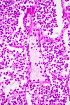 Micrograph of lobar pneumonia grey hepatization stage