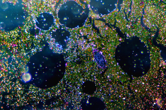 Micrograph of lobar pneumonia grey hepatization stage