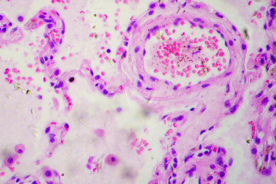 Micrograph of lobar pneumonia dissolution phase recovery stage
