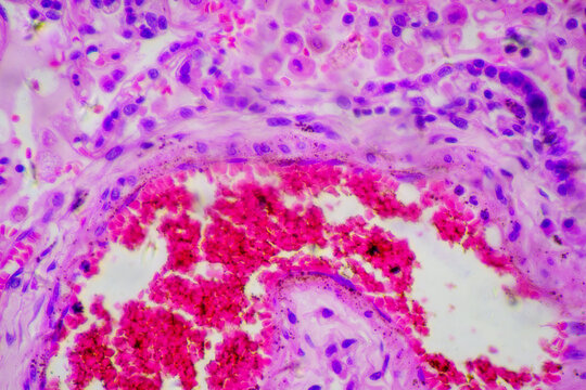 Micrograph of lobar pneumonia dissolution phase recovery stage
