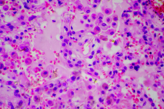 Micrograph of lobar pneumonia dissolution phase recovery stage