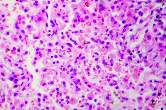 Micrograph of lobar pneumonia dissolution phase recovery stage