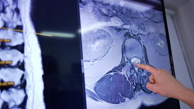 Male doctor's hand pointing at the MRI scan of a patient. Surgeon identifies the problem before the neurosurgery.