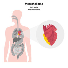 Mesothelioma, Pericardial mesothelioma