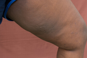Dark inner thigh on brown skin, hyperpigmentation and darkening of inner thigh on brown skin