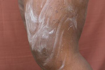 Lotion on brown skin with Eczema, Applying lotion on atopic dermatitis and prurigo nodularis on brown skin leg, ointment application on eczema breakout on dark skin