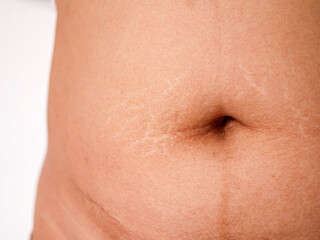 Abdominal scar marked pattern woman with warm white