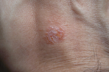 Close up of Nummular Dermatitis skin.