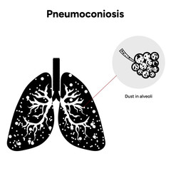 Pneumoconiosis, icons version, dust in alveoli 