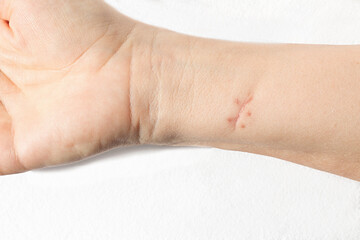 Scar from a sutured wound on white skin forearm. Isolated