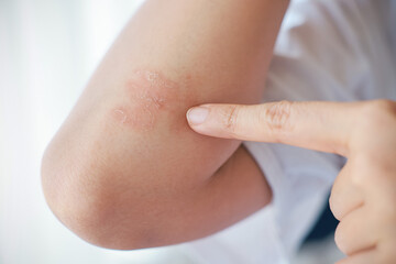 Close-up of skin Asian woman with acute psoriasis on her elbows. autoimmune incurable dermatological skin disease. A large red, inflamed, flaky rash on the elbows. skin by psoriatic arthritis.