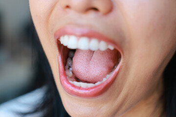 Close-up of tooth decay young Asia woman, So we should be care dental with the hygiene. Oral health...